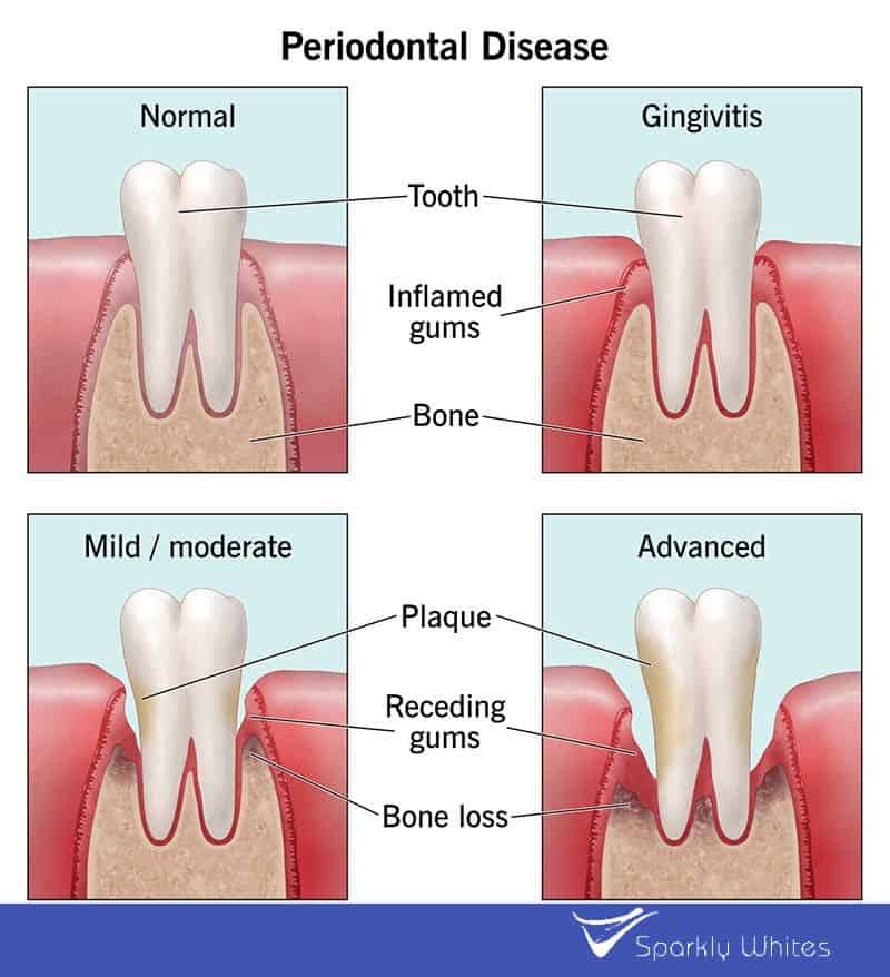 Can Gum Bleeding Really Indicate Poor Oral Hygiene Leighton Buzzard?