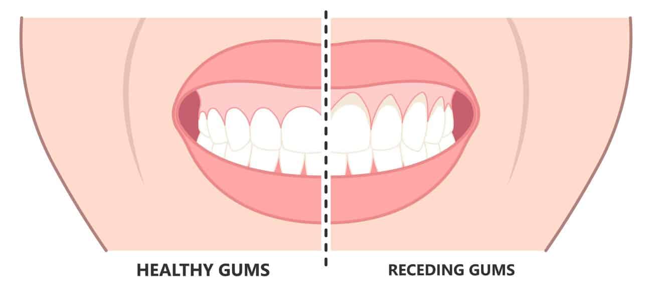 What Causes Gums to Recede Over Time Leighton Buzzard