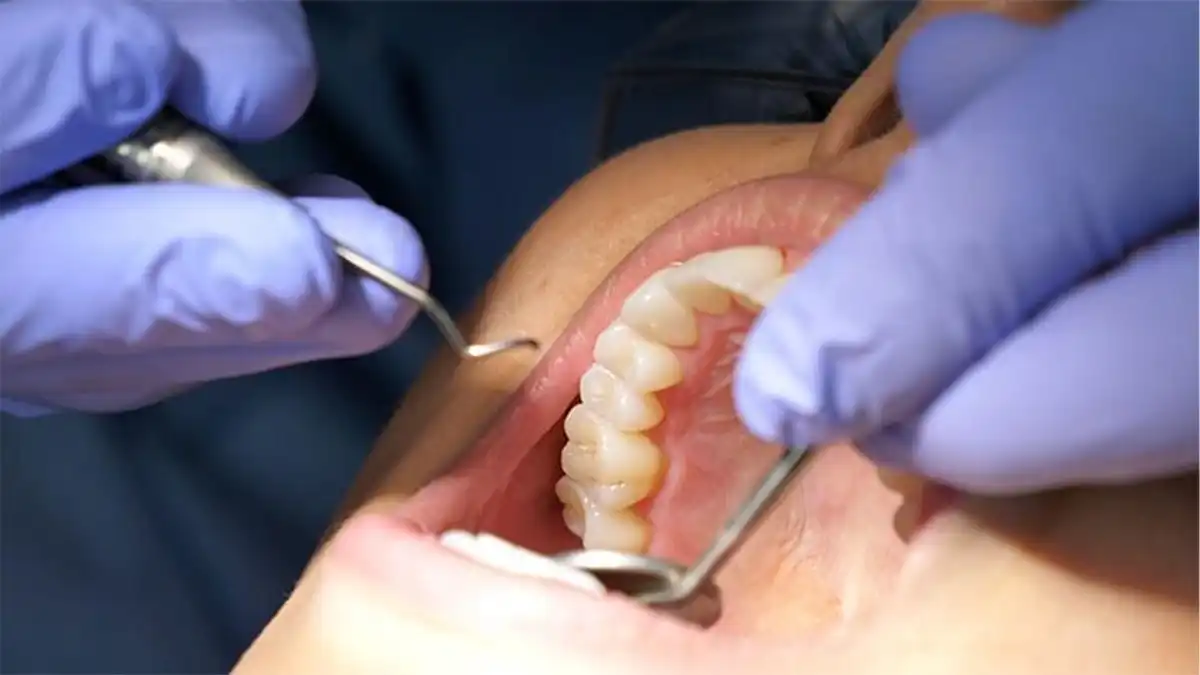 What's The Actual Difference Between Laser and Tray Teeth Whitening—And Why Should You Give a Floss Leighton Buzzard?